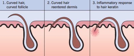 Ingrown Hair Causes